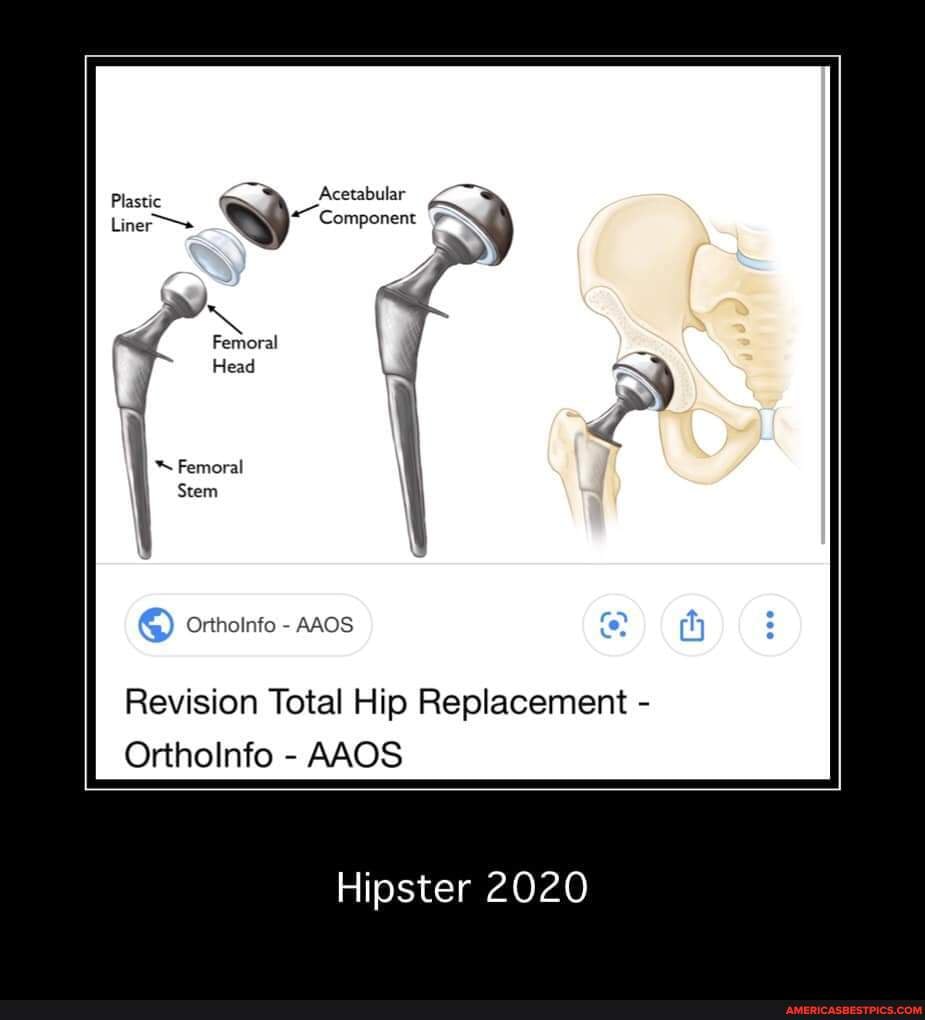 Plastic Acetabular Liner Component Femoral Stem Orthoinfo Aaos Revision Total Hip Replacement