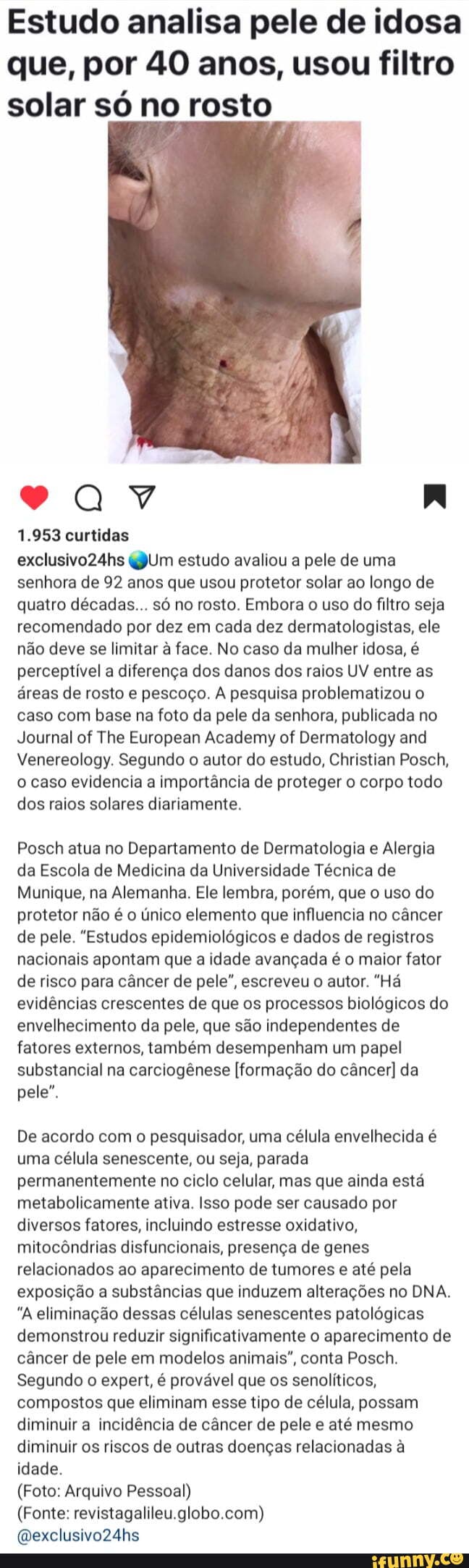 Estudo analisa pele de idosa que por 40 anos usou filtro solar só no