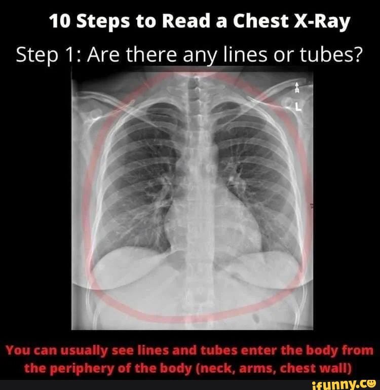 Learn How To Read A Chest X Ray In Steps Follow Radiology For Newbs For The Full Guide