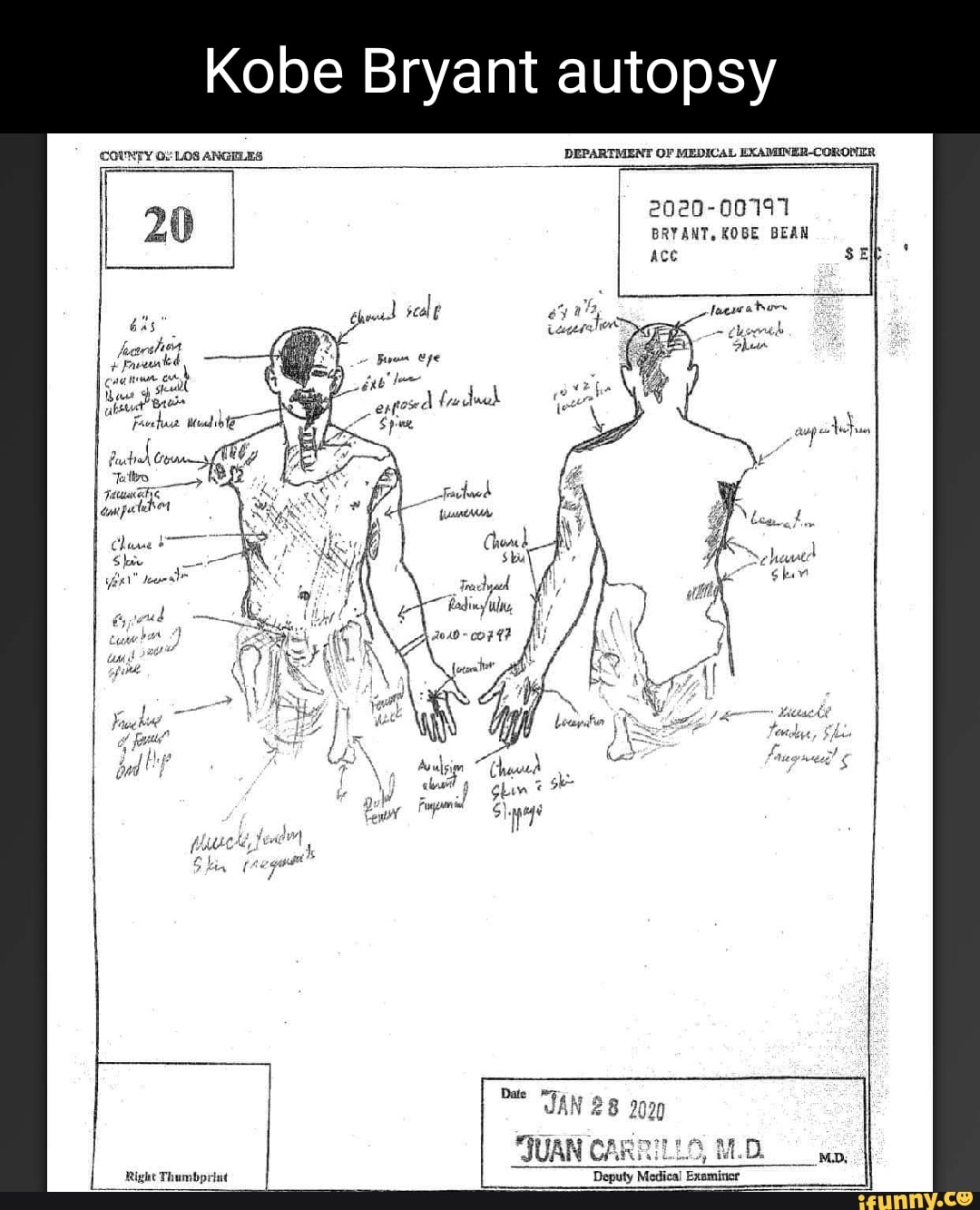 Kobe Bryant autopsy COUNTY LOS ANGELES DEPARTMENT OF MEDICAL EXAMINER