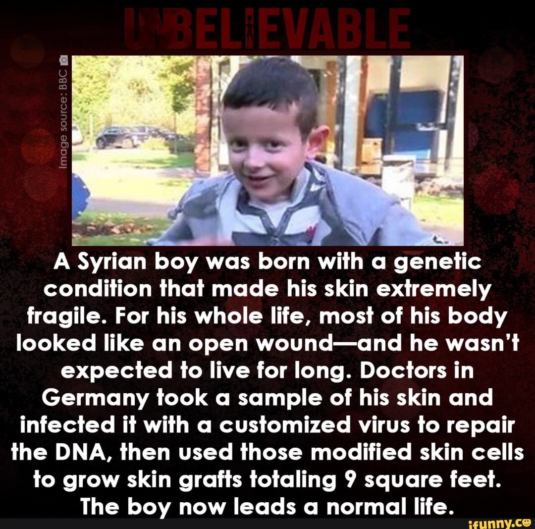 A Syrian boy was born with a genetic
condition that made his skin extremely
fragile. For his whole life, most of his body
looked like an open wound-and he wasn't
expected to live for long. Doctors in
Germany took a sample of his skin and
infected it with a customized virus to repair
the DNA, then used those modified skin cells
to grow skin grafts totaling 9 square feet.
The boy now leads a normal life.