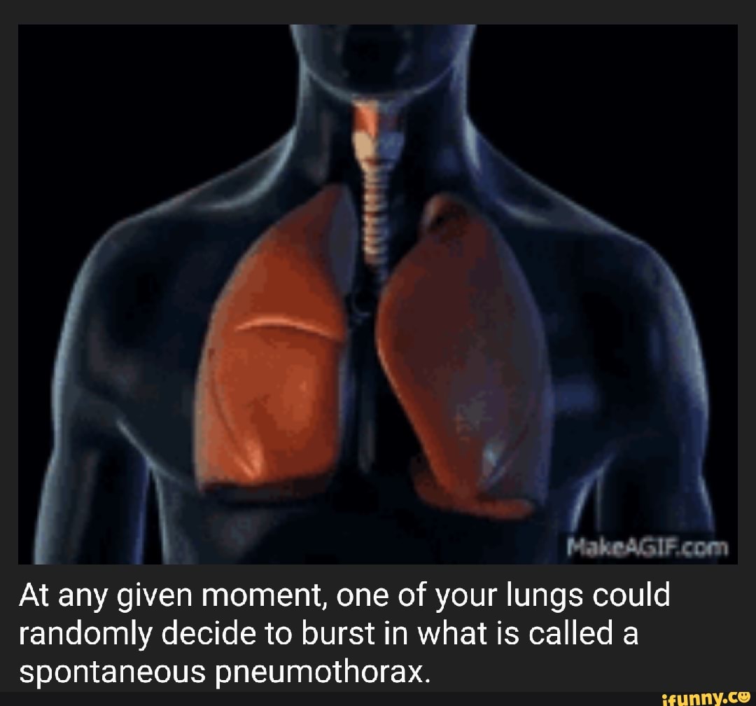 Pneumothorax memes. Best Collection of funny Pneumothorax pictures on ...