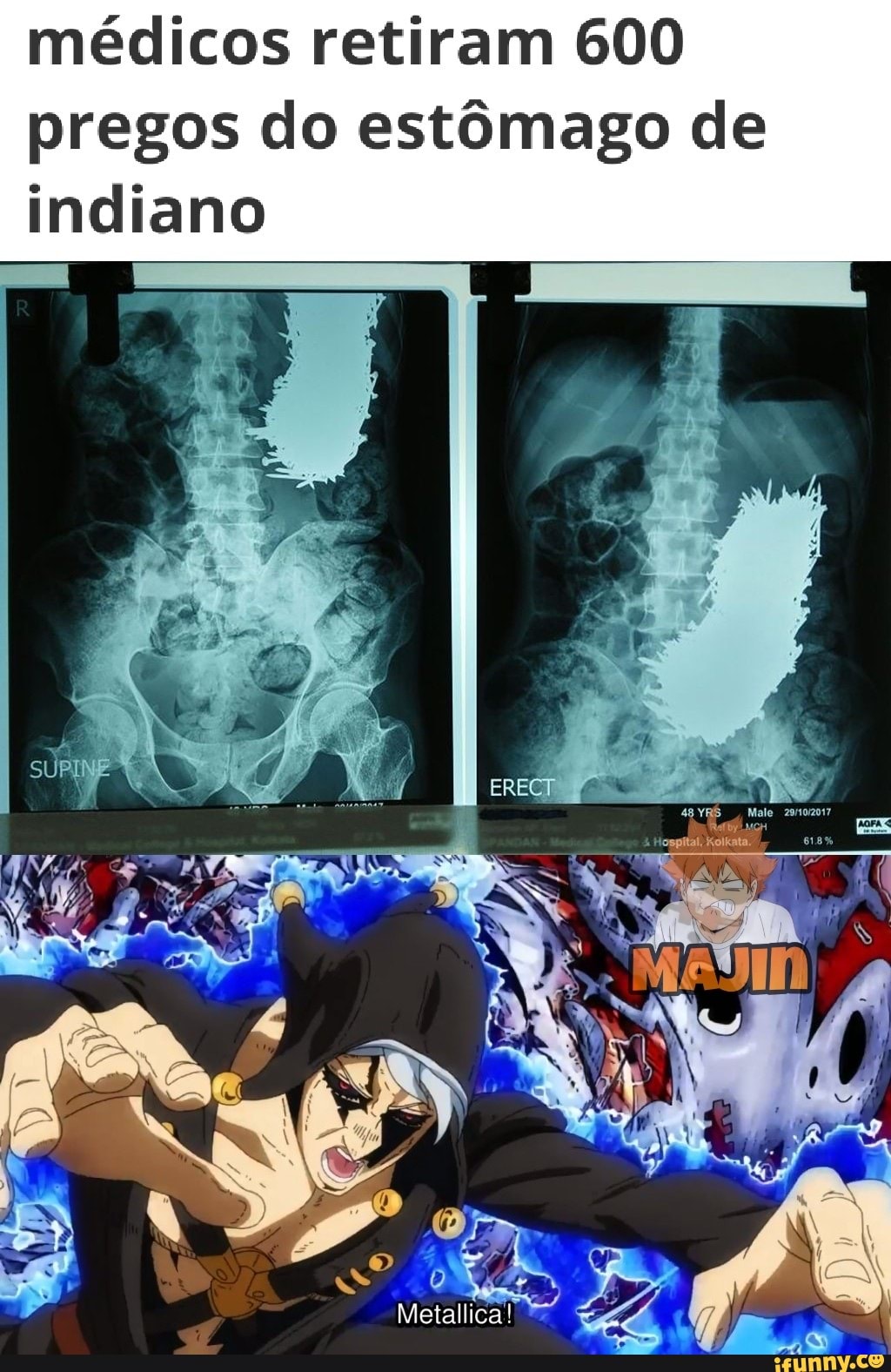 médicos retiram 600 pregos do estômago de indiano
ERECT
Metallica!