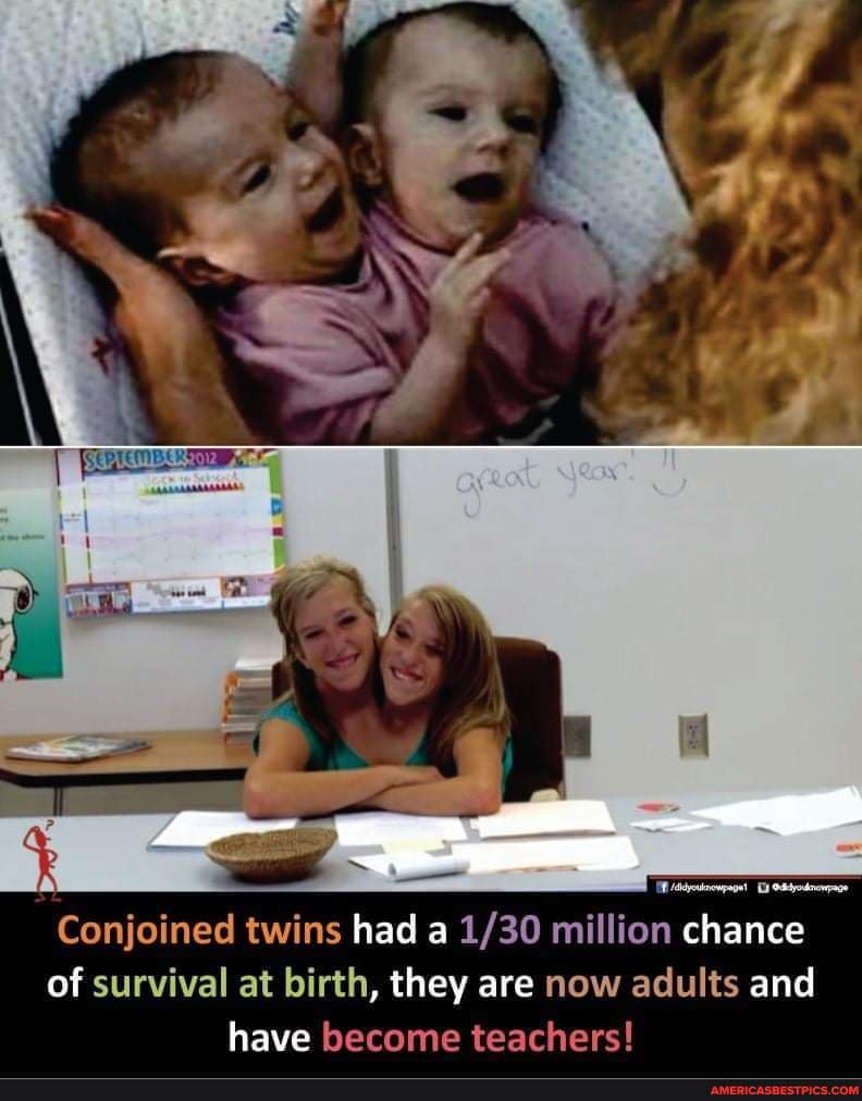 Conjoined twins had a million chance of survival at birth, they are now ...