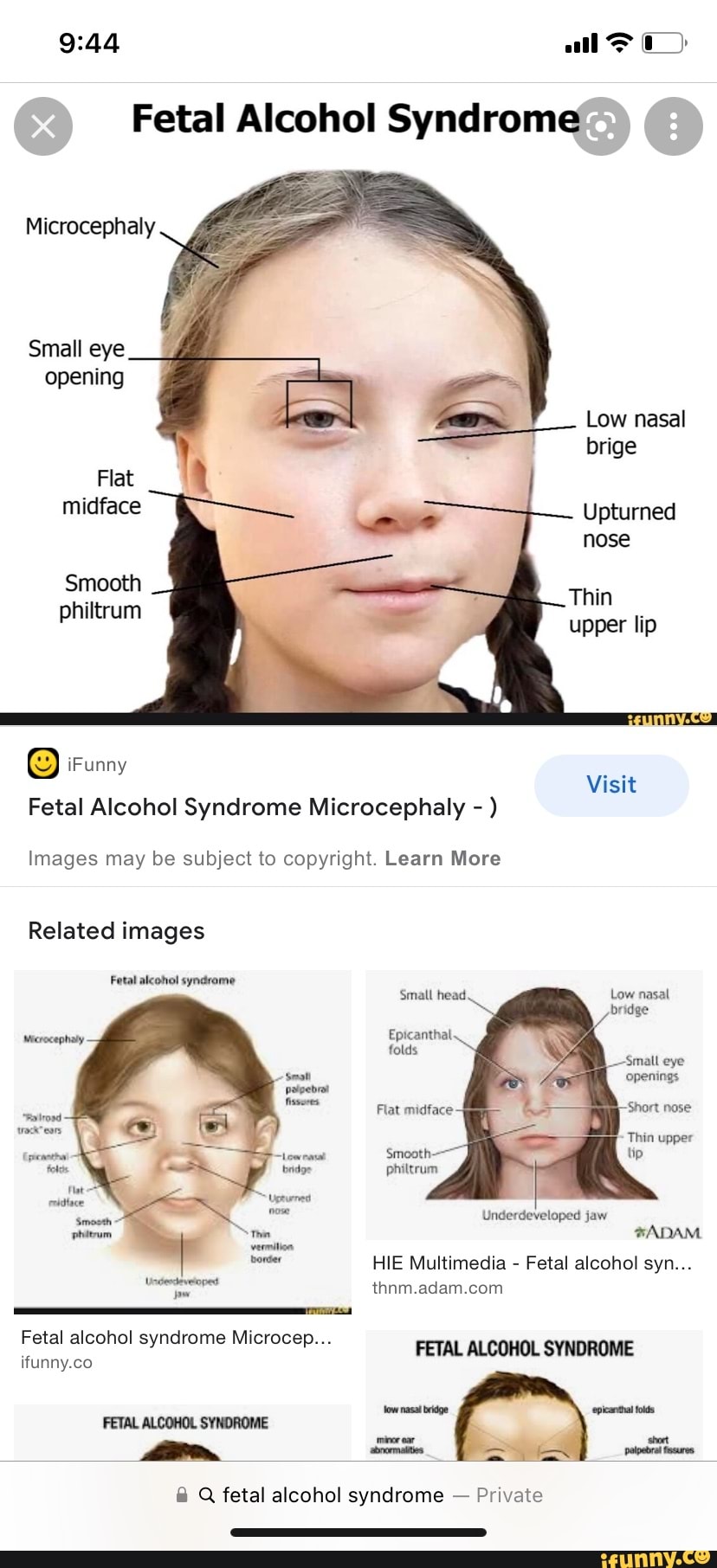 All Fetal Alcohol Syndrome Microcephaly Small eye opening Low nasal