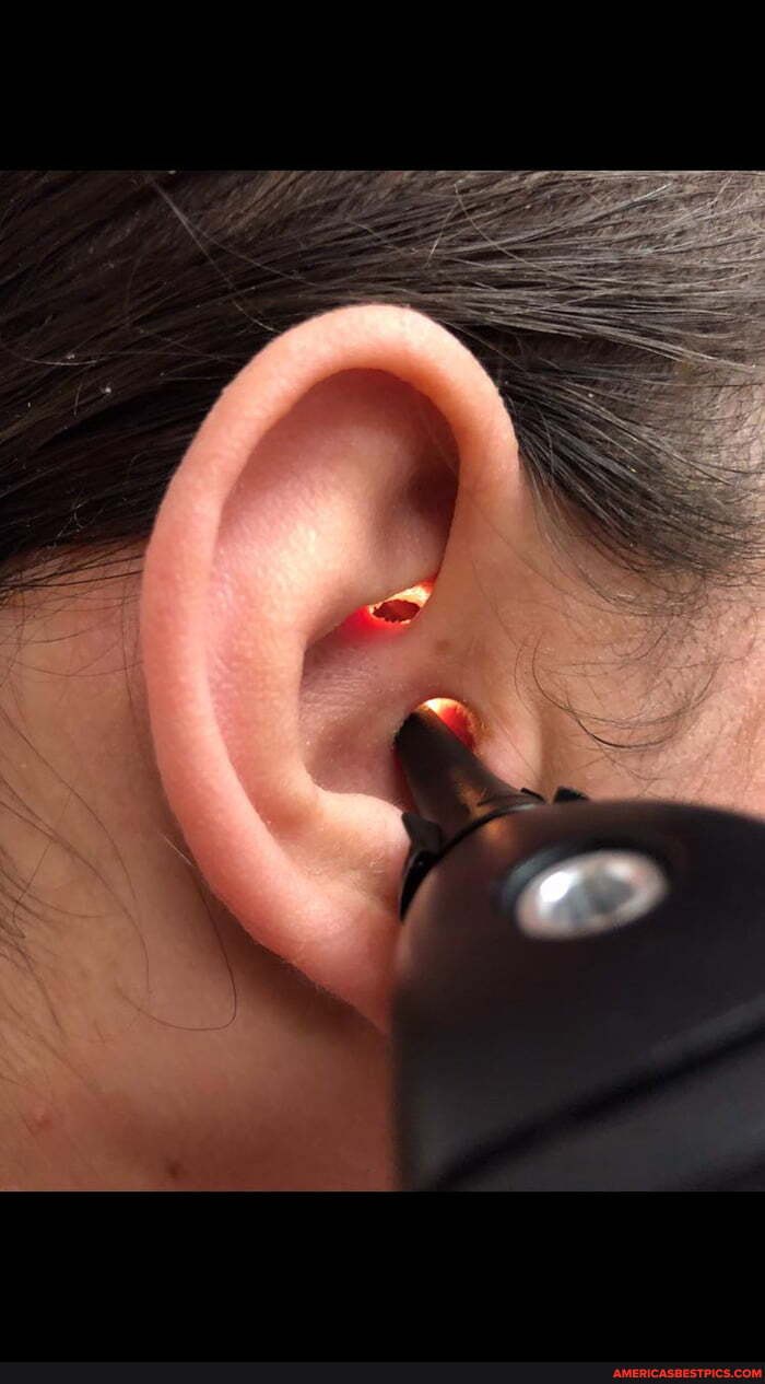 surgically, created, second, ear, canal, opening, anti, helix, tough, fi