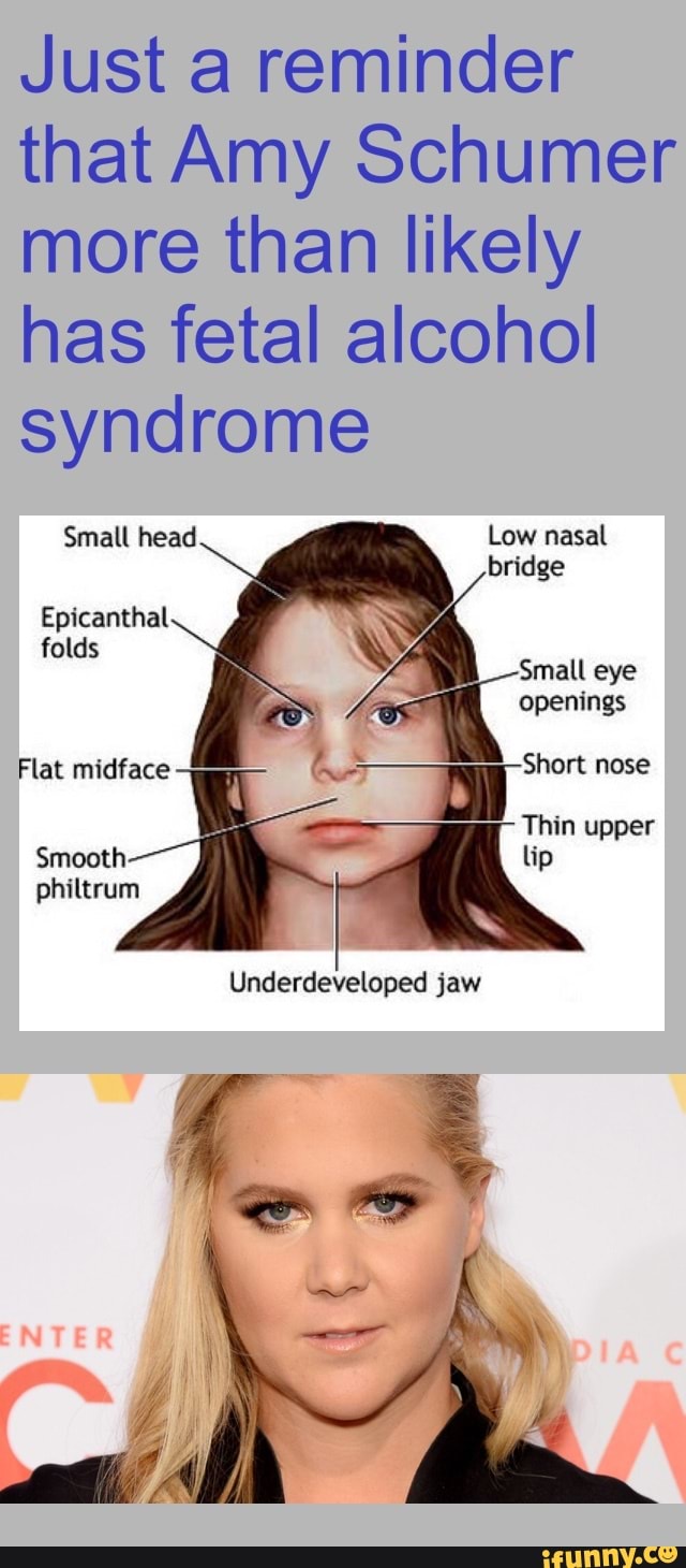 Just A Reminder That Amy Schumer More Than Likely Has Fetal Alcohol Syndrome Underdeveloped Jaw Ifunny