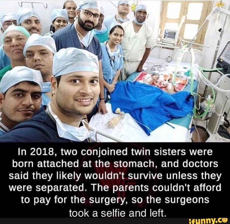 In 18 Two Conjoined Twin Sisters Were Born Attached At The Stomach And Doctors Said They
