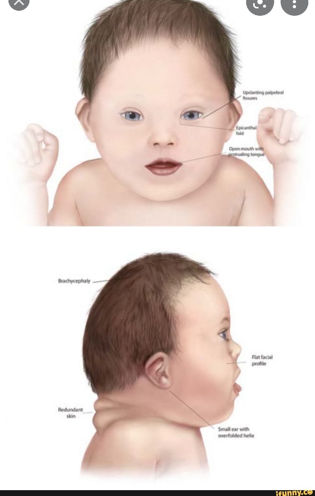 Синдром дауна 1 27. Синдром Дауна. Симптомы синдрома Дауна у новорожденных. Новорожденный с синдромом Дауна.