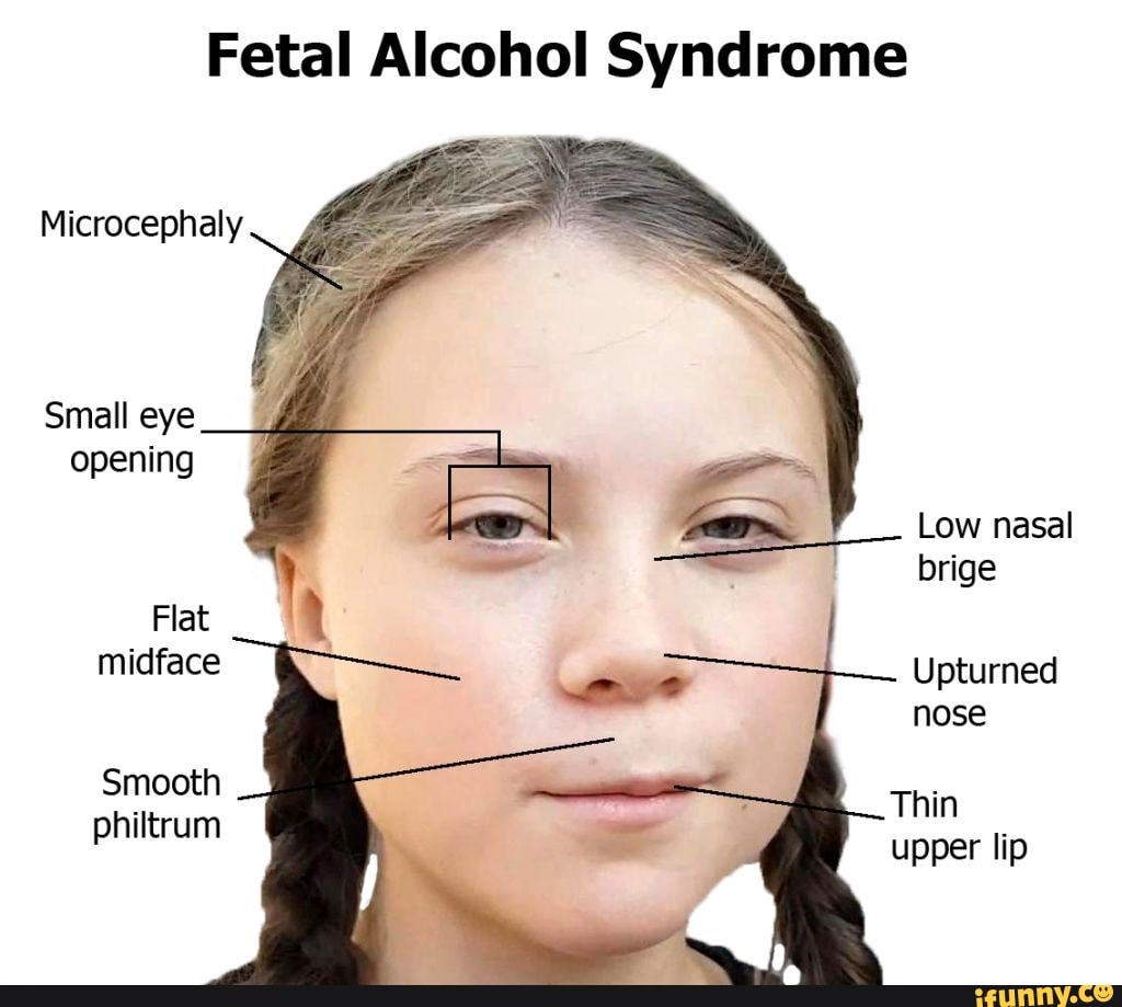 Fetal Alcohol Syndrome Microcephaly Small eye - iFunny Brazil
