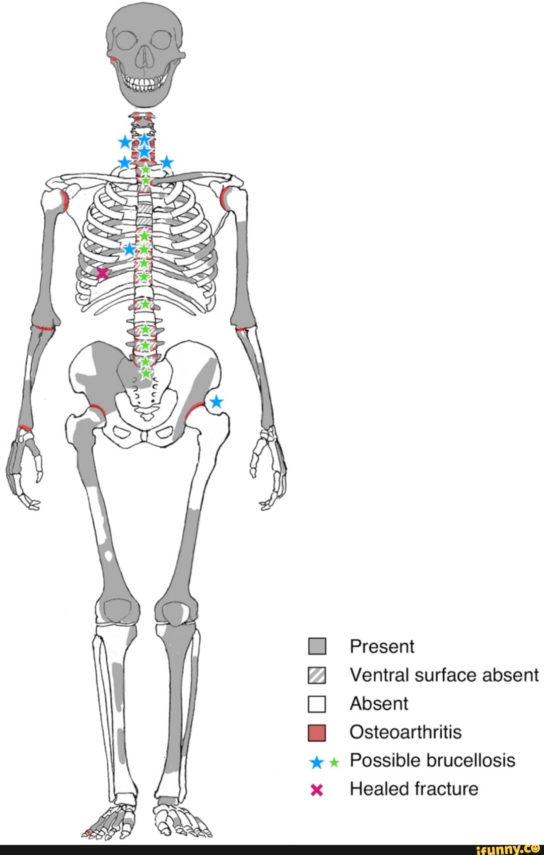 Present Ventral surface absent Absent Osteoarthritis Healed tracture