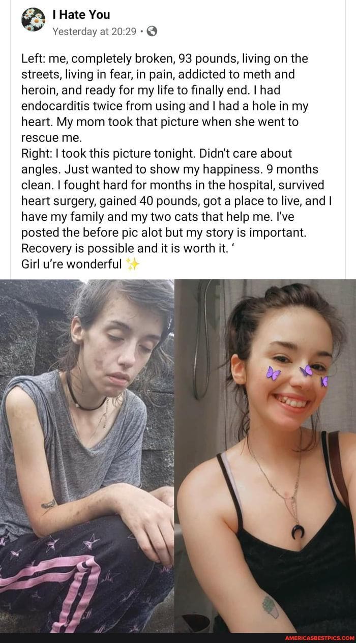 I Hate You
Yesterday at
Left: me, completely broken, 93 pounds, living on the streets, living in fear, in pain, addicted to meth and heroin, and ready for my life to finally end. I had endocarditis twice from using and had a hole in my heart. My mom took that picture when she went to rescue me.
Right: I took this picture tonight. Didn't care about angles. Just wanted to show my happiness. 9 months clean. I fought hard for months in the hospital, survived heart surgery, gained 40 pounds, got a place to live, and I have my family and my two cats that help me. I've posted the before pic alot but my story is important.
Recovery is possible and it is worth it.
Girl u're wonderful