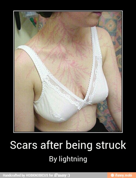 Scars after being struck
By lightning - Scars after being struck
By lightning