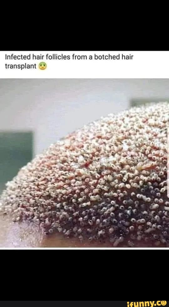 Infected hair follicles from a botched hair transplant )