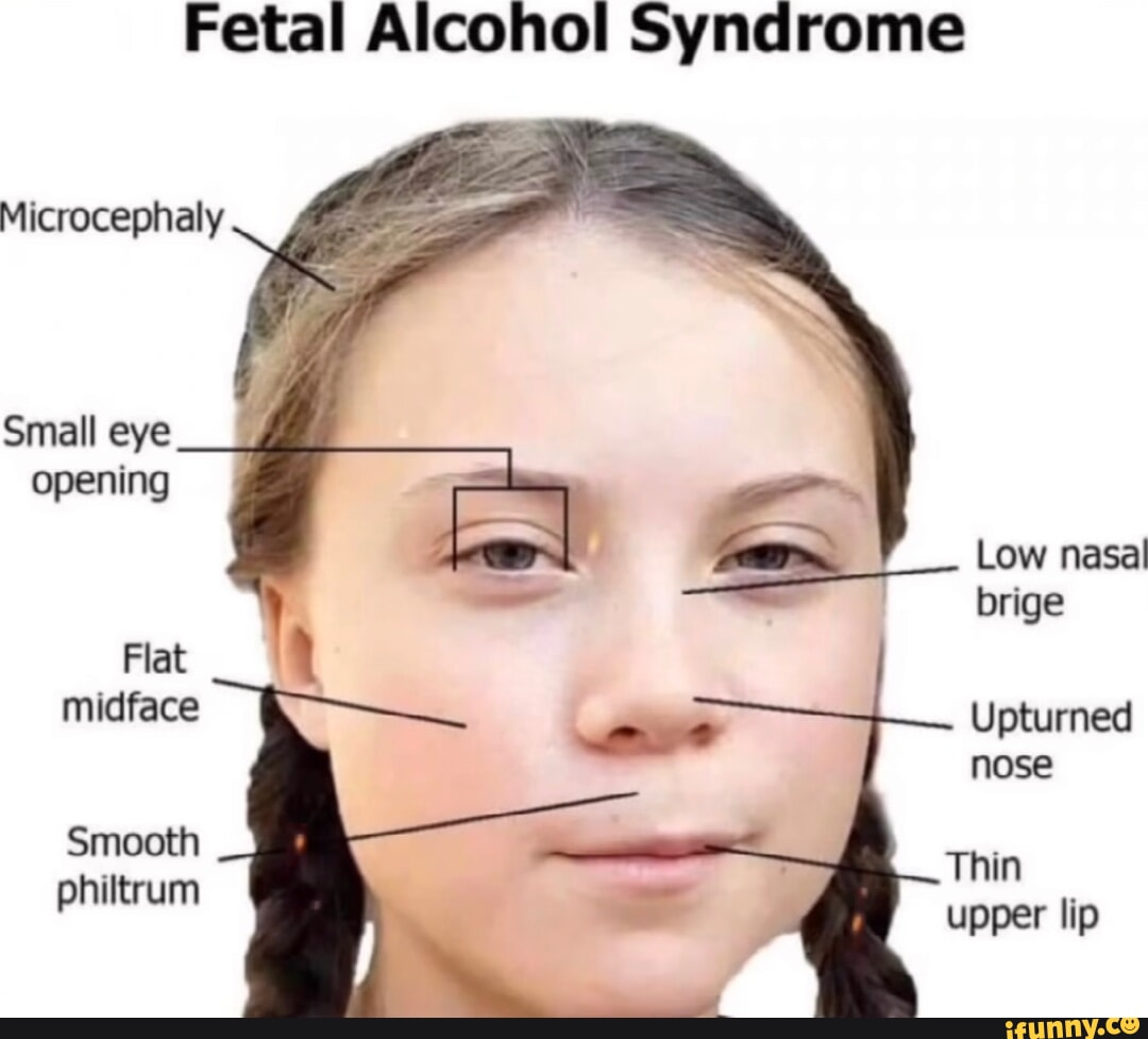 fetal-alcohol-syndrome-microcephaly-small-eye-opening-low-nasal-brige