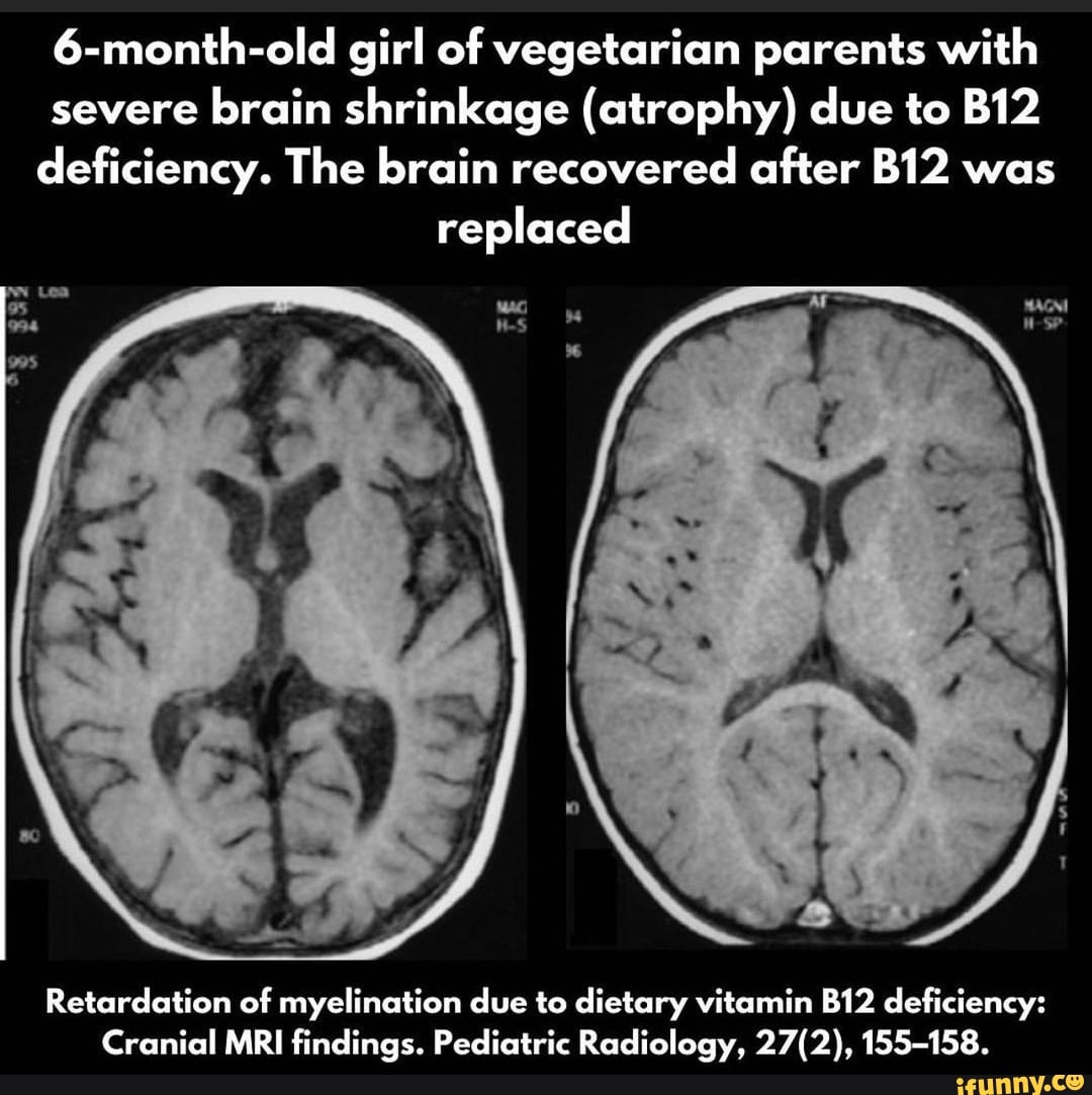6monthold girl of vegetarian parents with severe brain shrinkage