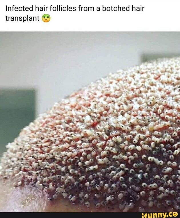 Infected Hair Follicles From A Botched Hair Transplant IFunny