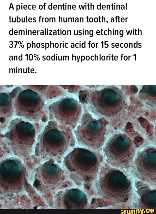 A piece of dentine with dentinal
tubules from human tooth, after
demineralization using etching with
37% phosphoric acid for 15 seconds
and 10% sodium hypochlorite for 1
minute.