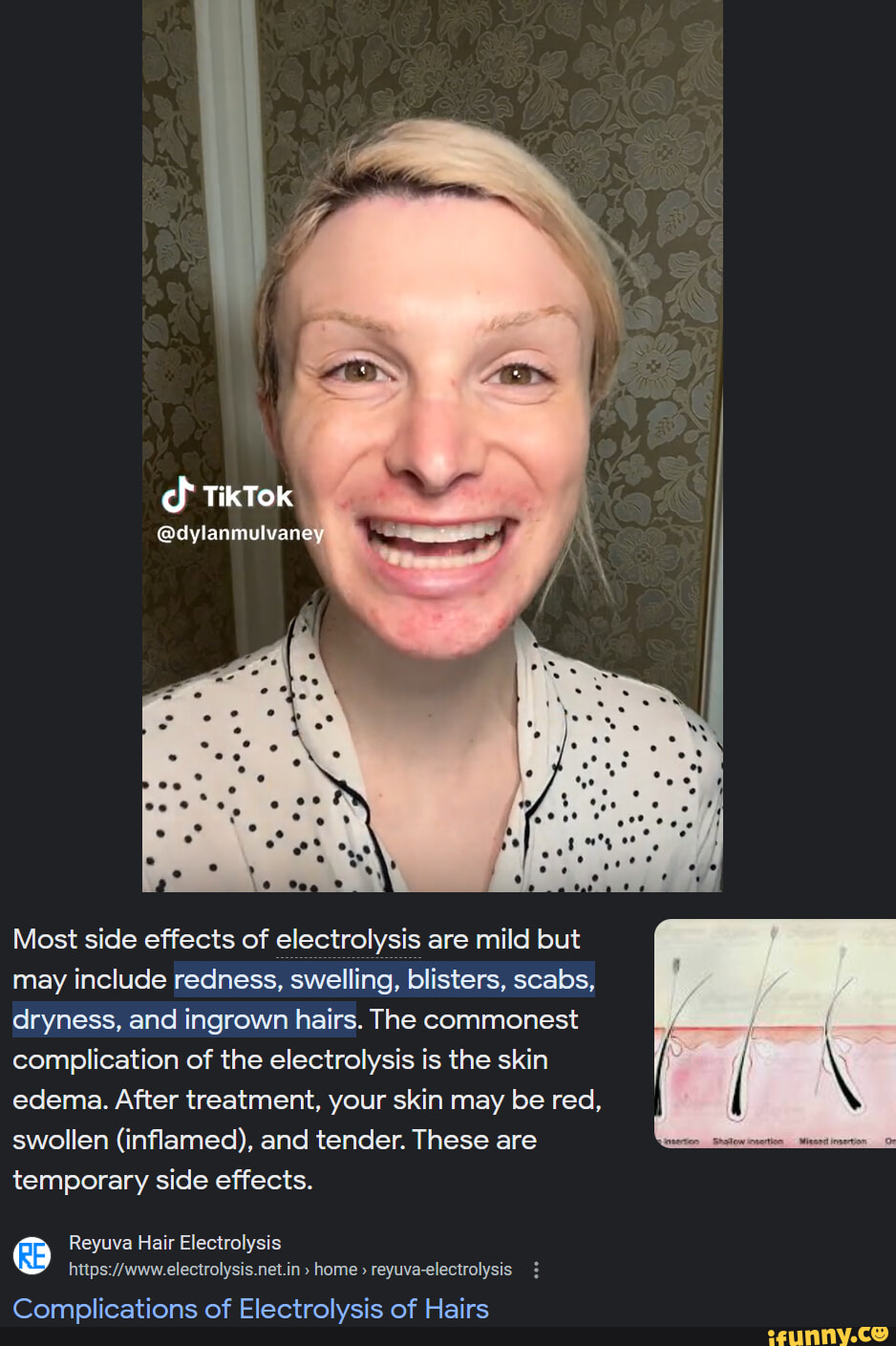 Dylan Mulvaney's electrolysis I TikTok dylanmulvaney Most side