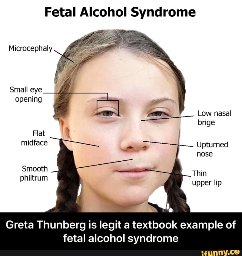 adult with fetal alcohol syndrome face
