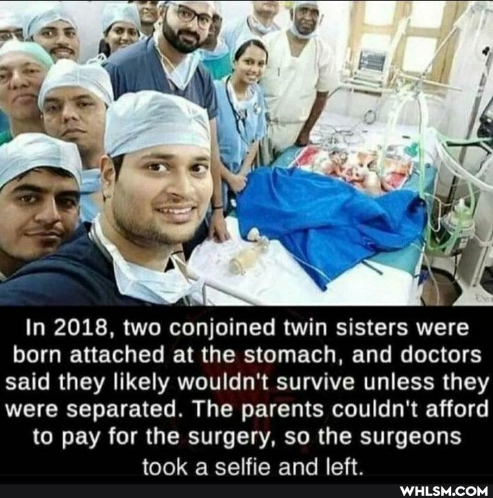 In 2018, two conjoined twin sisters were born attached at the stomach, and doctors said they likely wouldn't survive unless they were separated. The parents couldn't afford to pay for the surgery, so the surgeons
a ealfia and lat
