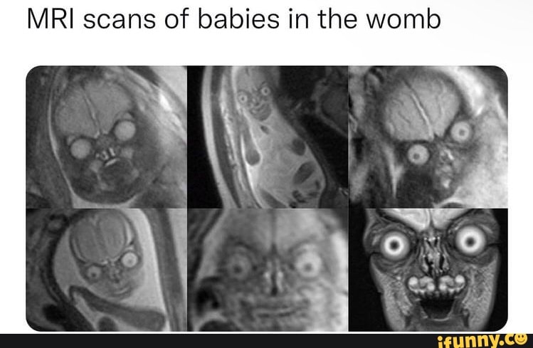 mri-scans-of-babies-in-the-womb