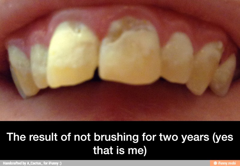 The result of not brushing for two years (yes
that is me) - The result of not brushing for two years (yes that is me)