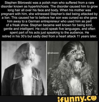 Stephen Bibrowski was a polish man who suffered from a rare
disorder known as hypertrichosis. The disorder caused him to grow
long hair ll over his face and body. When his mother was
pregnant with him, she witnessed Stephen's dad being attacked by
'lion, Tis caused her to believe her son was cursed so she gave
him away to a German entrepreneur who used him as part
of freak show. Stephan became well known for being kind,
{gentle and intligent. He could speak five languages, and often
spent pat of his acs just speaking to the audience. He
retired in his 30s but sadly died from a heart attack 11 years later