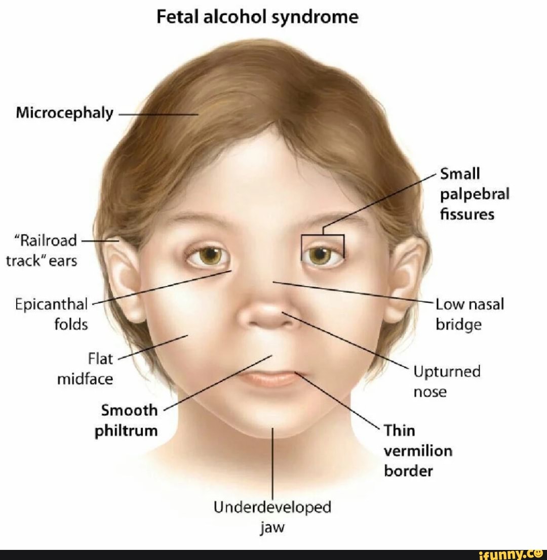 Fetal alcohol syndrome Microcephaly Small palpebral fissures "Railroad