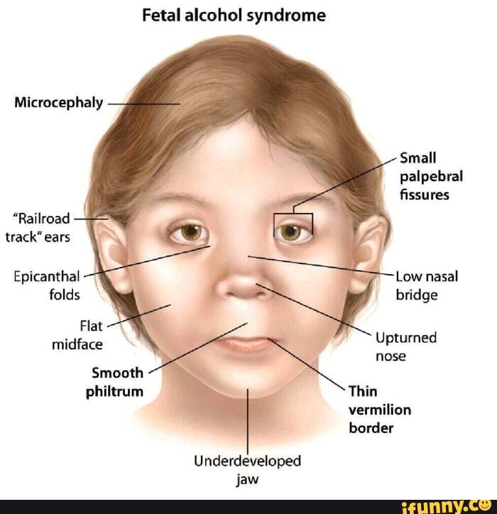 Fetal alcohol syndrome Microcephaly Small palpebral fissures 