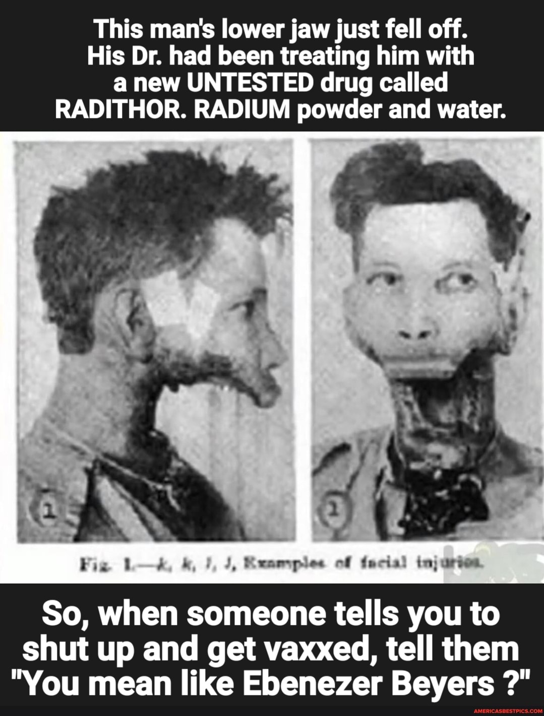 guy whose jaw fell off from radium