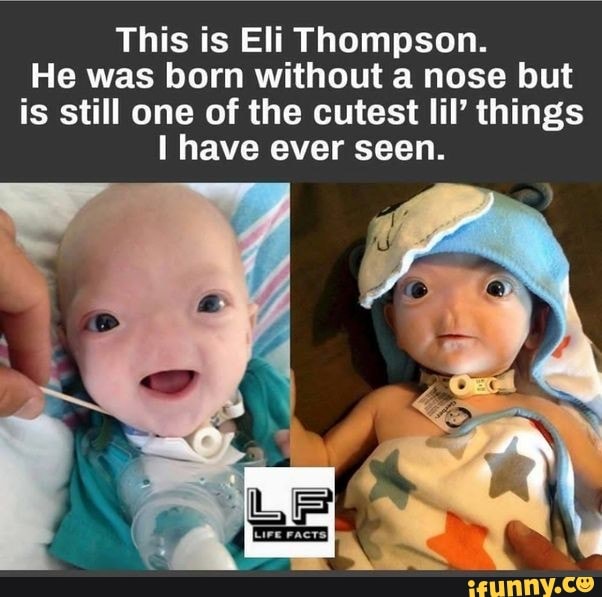 This is Eli Thompson. He was born without a nose but is still one of ...