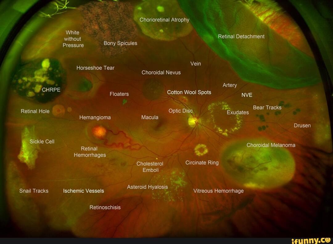 White without Pressure Horseshoe Tear Bony Spicules Chorioretinal