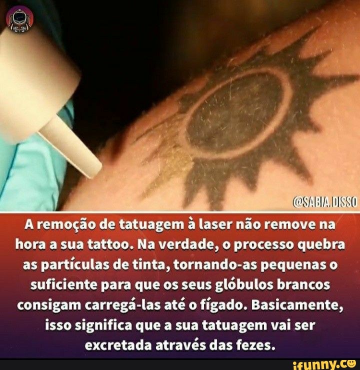 AR
A remoção de tatuagem à laser não remove na hora a sua tattoo. Na verdade, o processo quebra as partículas de tinta, tornando-as pequenas o suficiente para que os seus glóbulos brancos consigam carregá-las até o figado. Basicamente, isso significa que a sua tatuagem vai ser excretada através das fezes.