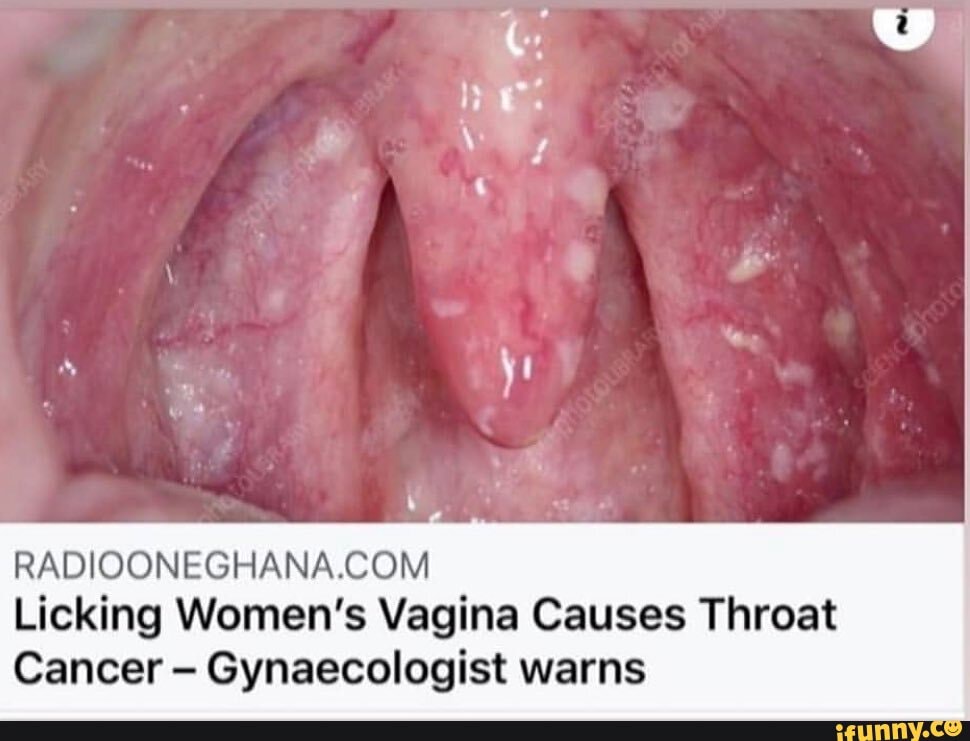 Licking Women's Vagina Causes Throat Cancer Gynaecologist warns.