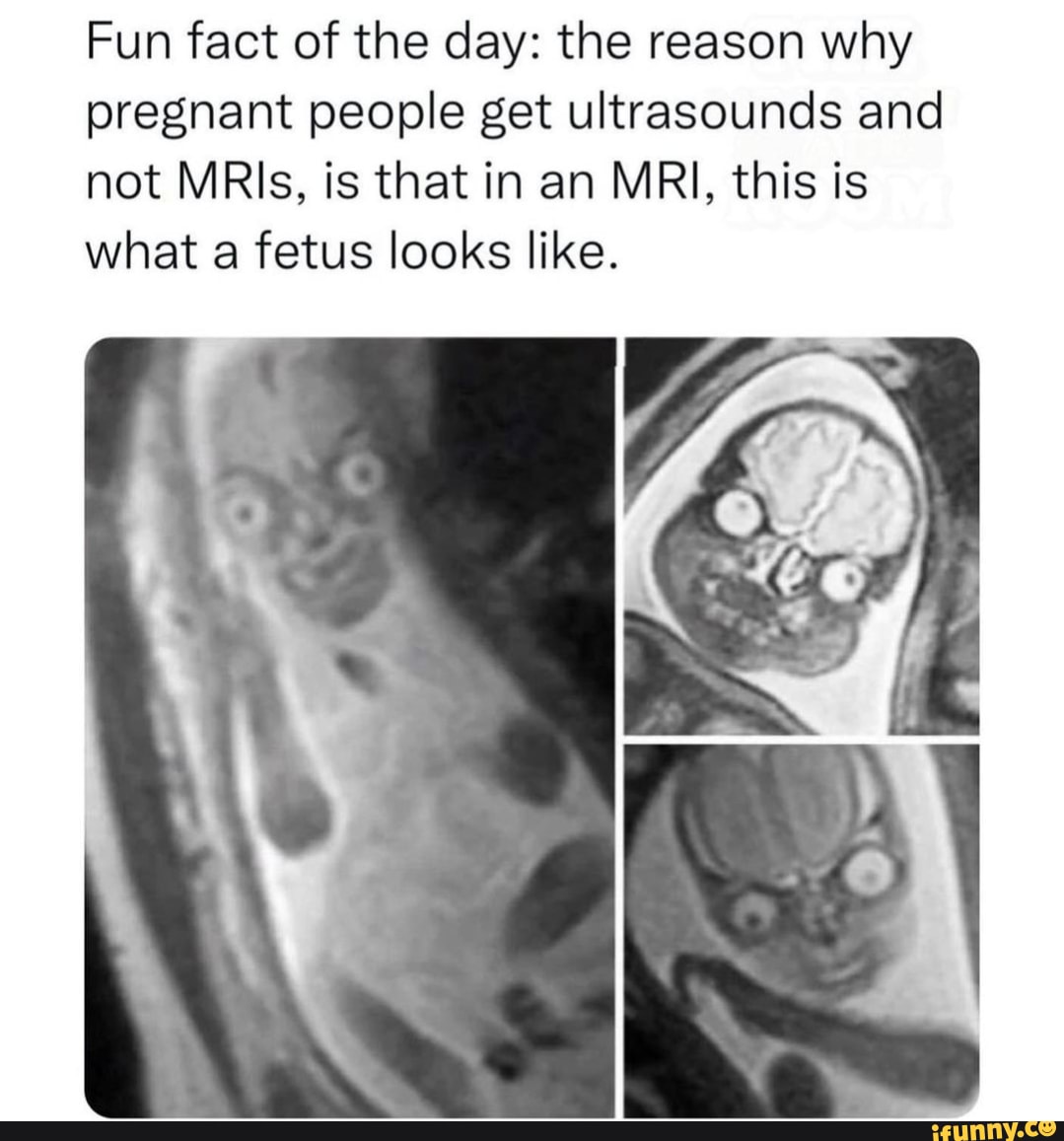 fun-fact-of-the-day-the-reason-why-pregnant-people-get-ultrasounds-and