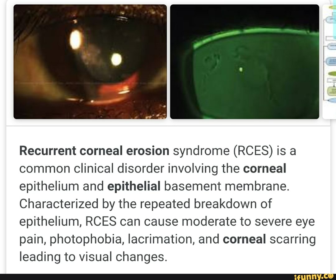 Recurrent Corneal Erosion Syndrome Rces Is A Common | My XXX Hot Girl