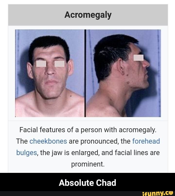 Acromegaly Facial features of a person with acromegaly. The cheekbones ...