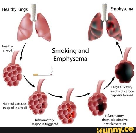 Healthy lungs Emphysema Heatthy alveolt Smoking and \ Emphysema ed with ...