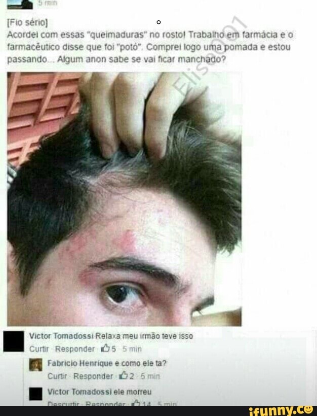 [Fio sério) o
Acordei com essas "queimaduras" no rosto! Trabalhó em farmácia e o
farmacêutico disse que foi "potó". Comprei logo uma pomada e estou
passando. Algum anon sabe se vai ficar manchado?
= Victor Tomadossi Relaxa meu irmão teve isso
Curtir Responder 455
a Fabricio Henrique e como ele ta?
ponder 2-5
Victor Tomadossi ele morreu