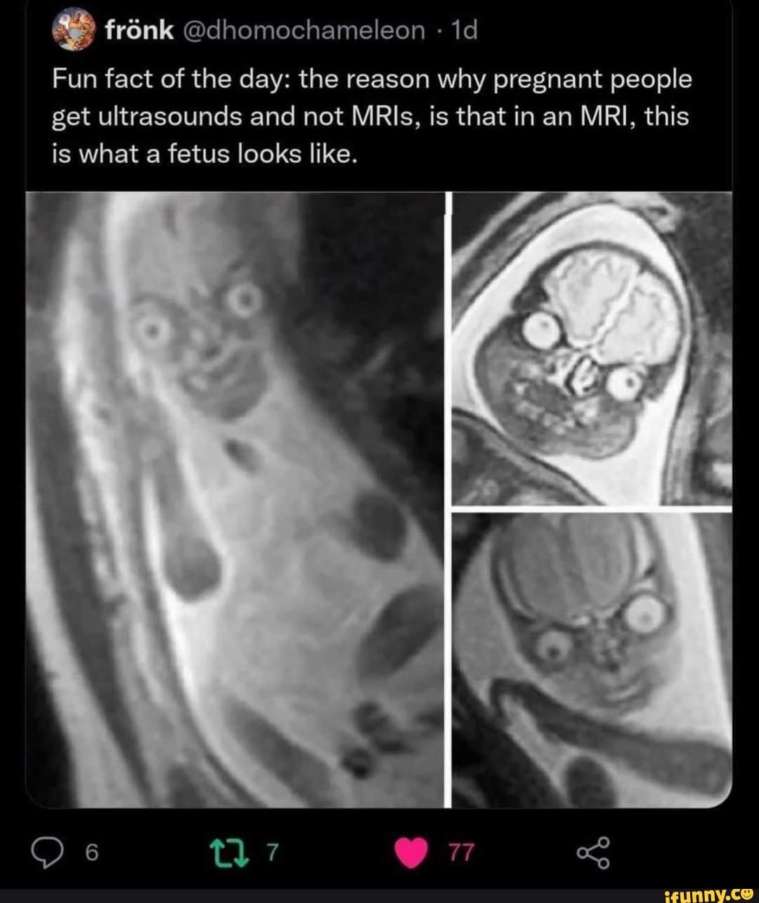 Fun fact of the day the reason why pregnant people get ultrasounds and