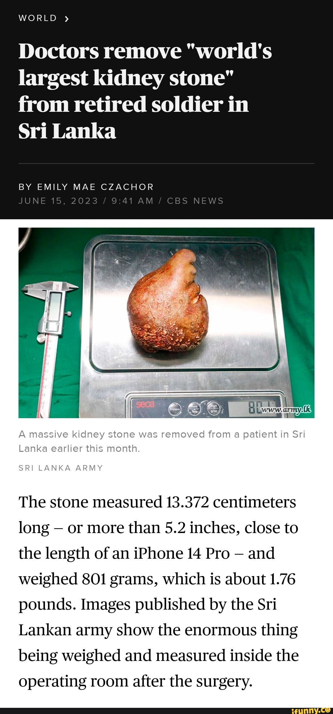 WORLD " Doctors remove "world's largest kidney stone" from retired