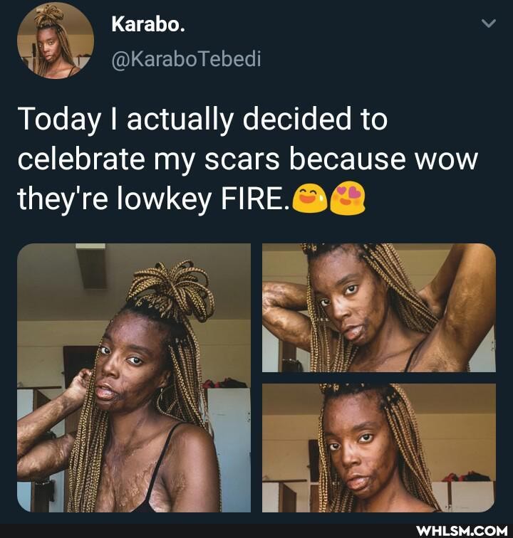 Karabo.
@KaraboTebedi
Today I actually decided to celebrate my scars because wow they're lowkey FIRE.
