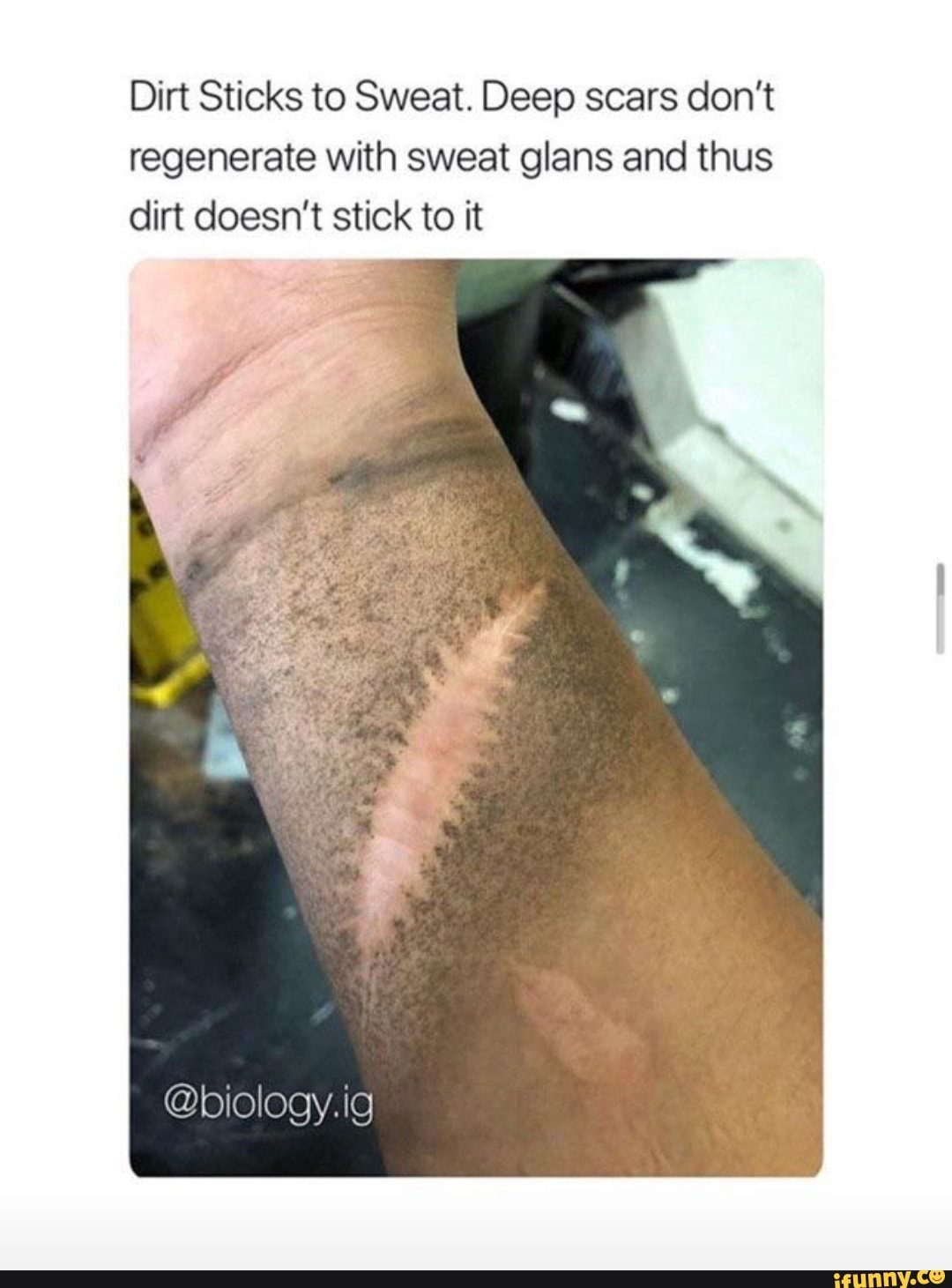 Dirt Sticks to Sweat. Deep scars don't
regenerate with sweat glans and thus
dirt doesn't stick to it