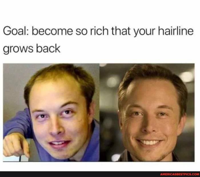 Goal: become so rich that your hairline grows back
