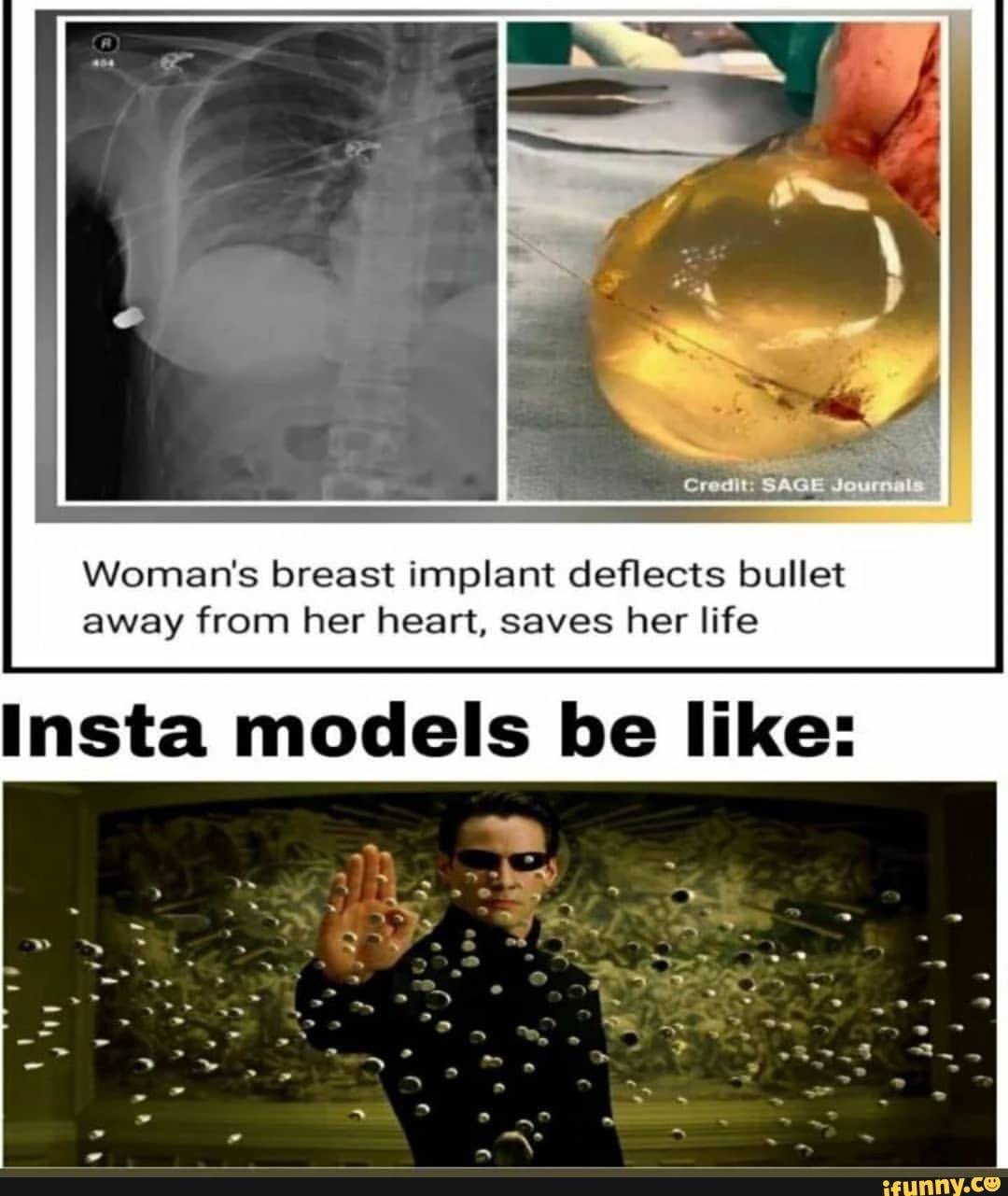 Sag Womans Breast Implant Deflects Bullet Away From Her Heart Saves