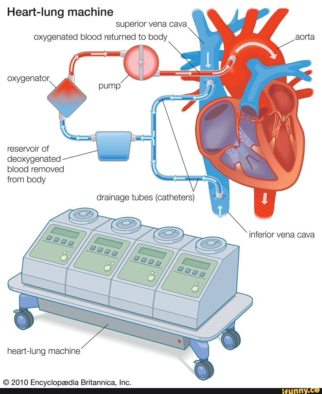Heartlung machine superior vena cava oxygenated blood returned to body