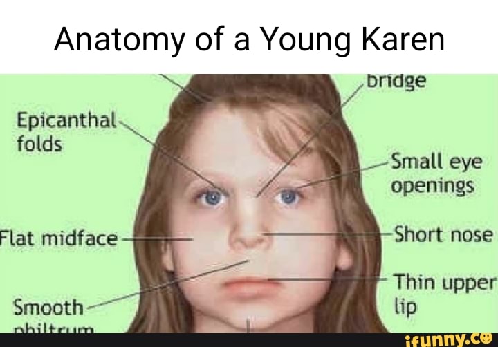 Anatomy of a Young Karen bridge Epicanthal folds mall eye openings