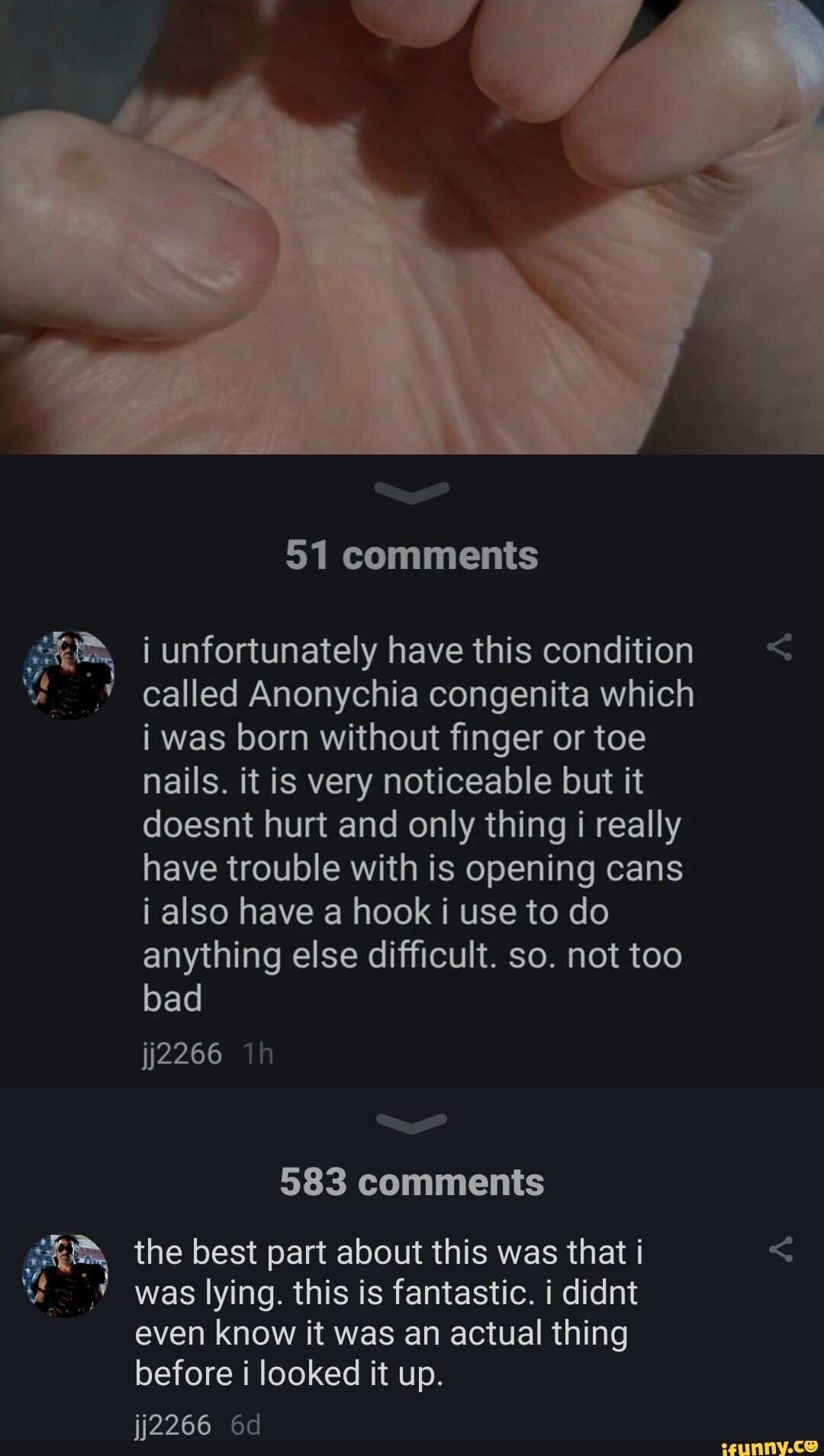 51 comments i unfortunately have this condition called Anonychia ...