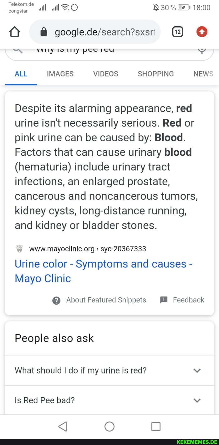 tl BO 830%.
congstar
ALL IMAGES VIDEOS SHOPPING NEW:
Despite its alarming appearance, red urine isn't necessarily serious. Red or pink urine can be caused by: Blood.
Factors that can cause urinary blood
(hematuria) include urinary tract infections, an enlarged prostate, cancerous and noncancerous tumors, kidney cysts, long-distance running, and kidney or bladder stones.
syc-20367333
Urine color - Symptoms and causes -
Mayo Clinic
@ About Featured Snippets Feedback
People also ask
What should I do if my urine is red?
Is Red Pee bad?
<J OO oo